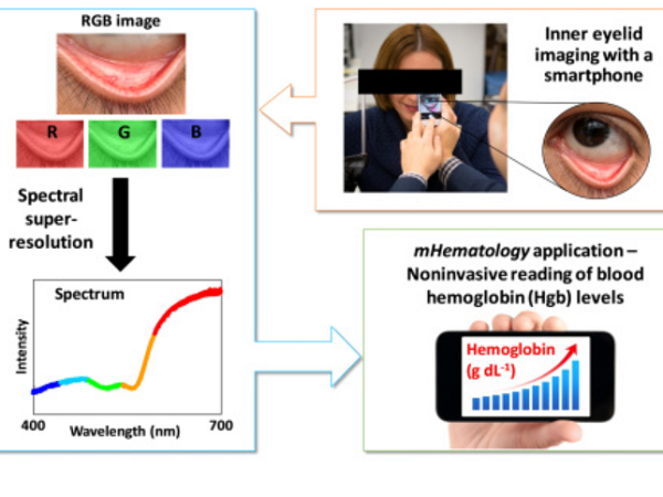 まぶたの写真を撮って貧血を診断 パデュー大らがスマホアプリによる検査技術を開発 Techable テッカブル